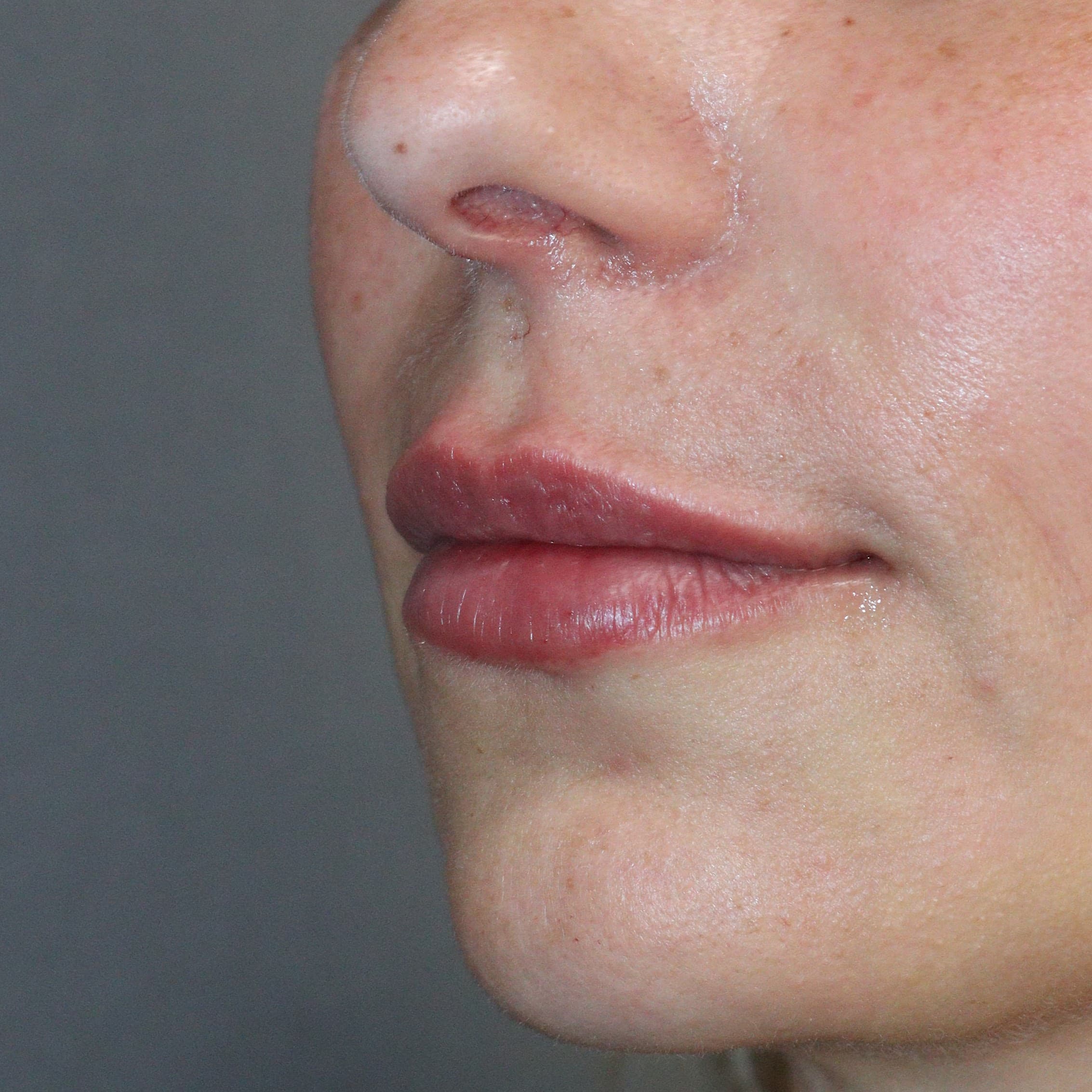 Preenchimento Labial - Depois